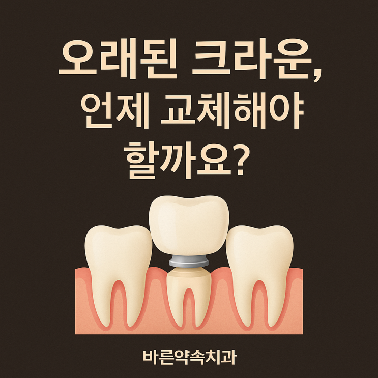   오래된 크라운, 언제 교체해야 할까요?