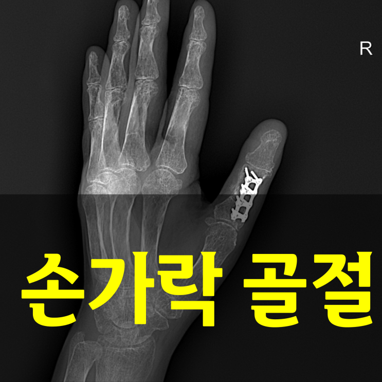  손가락 마디 골절, '뚝' 소리와 함께 찾아온 막막함, 회복 기간과 관리법 총정리