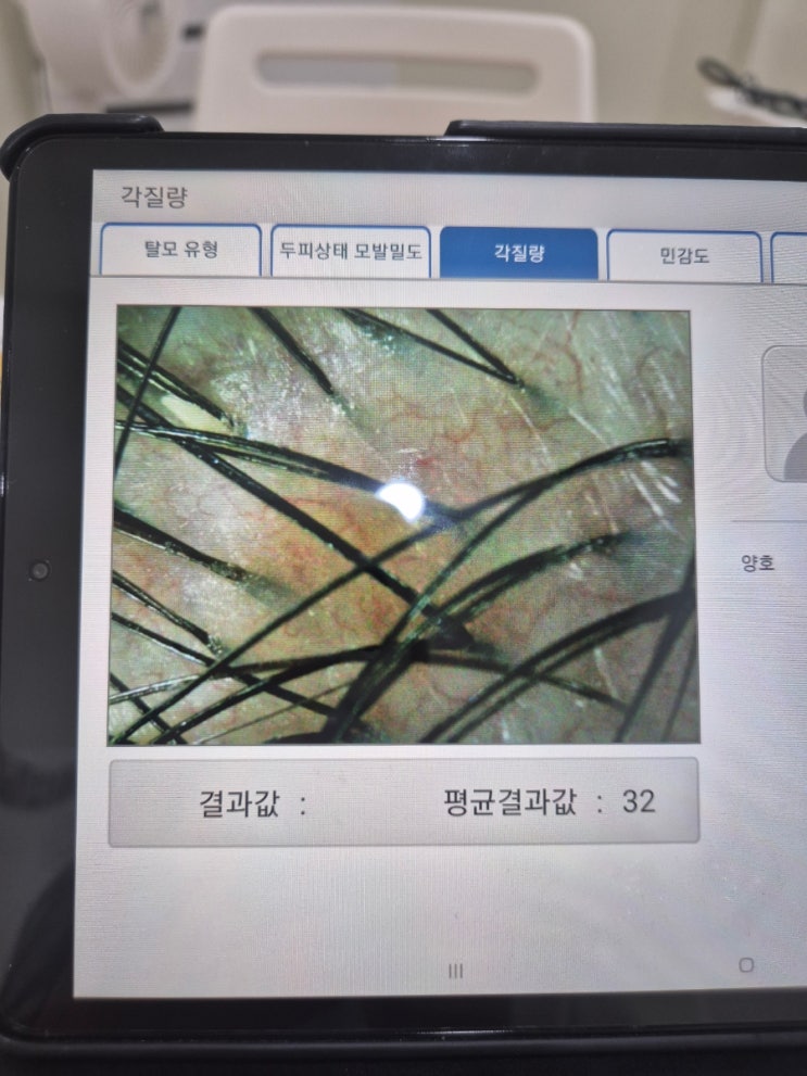  안산 두피관리 오늘두탈모피하자 후기