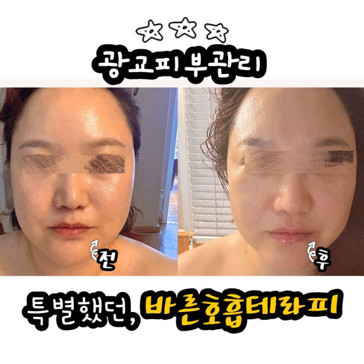  특별했던 광교피부관리