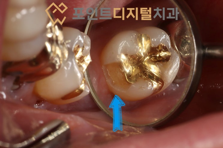  [탕정치과]  치아파절부위 크라운 대신 레진으로 치료하기 / 천안 아산