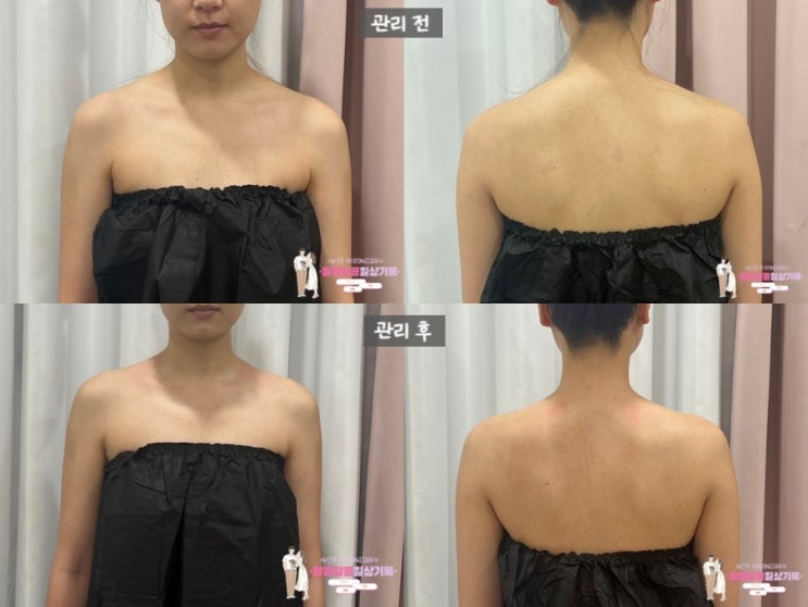  신사동에스테틱 '더좋은피부' LDM 물방울 리프팅 만족후기