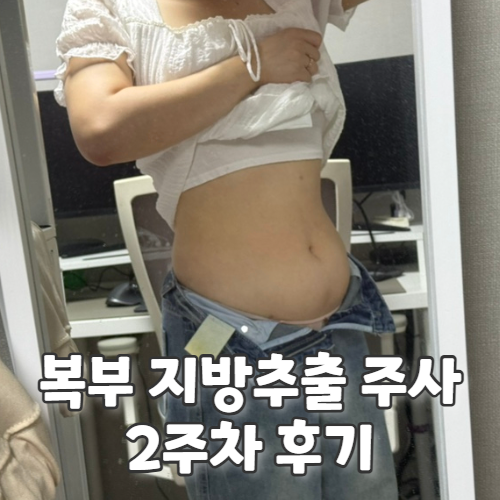  복부 지방추출주사 후기 멍과 붓기 부작용은 2주차 찐후기