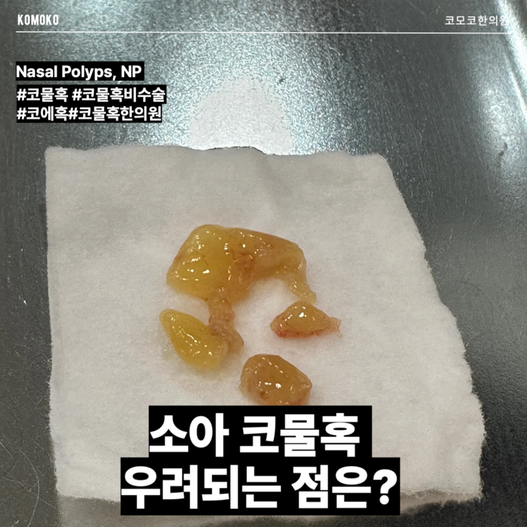  소아 코물혹을 비수술로 제거하는 방법