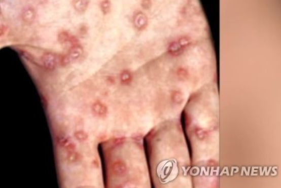   지난해 매독 환자 2790명… 20~30대 남성이 60% 이상