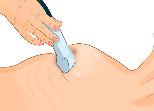  유방 통증 결절 멍울 물혹 의심될땐 유방 초음파 해보세요