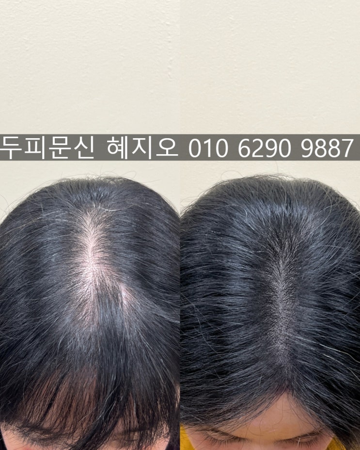  부천 여성 정수리 가르마 커버에 두피페인팅 강추하는 이유