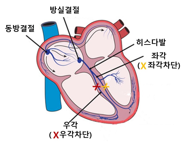 건강 검진 심전도에서 우각차단, 좌각차단이라 하는데 어떤 의미 인가요?