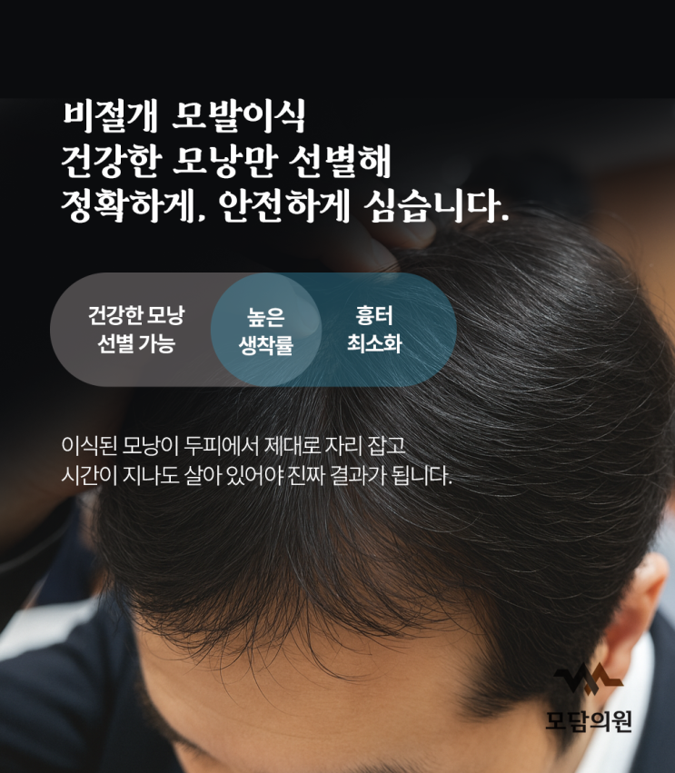  군산 익산 모발이식 병원 찾는다면? 20년 경력의 모담의원