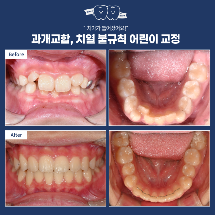  하남 어린이 교정, 영구치 나올 때까지 책임감 있는 관리가 중요한 이유! (소아치과 X 치과 교정과 협진)