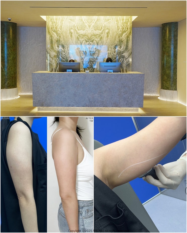  팔 지방분해주사 후기 팔뚝 주사 가격 여자 팔뚝살 원인 빼는법