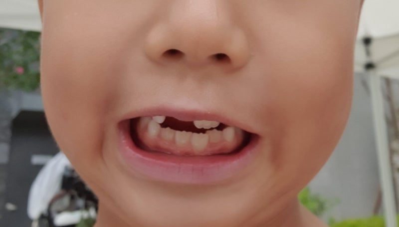 유아 치아교정 언제 시작하는 게 좋을까?