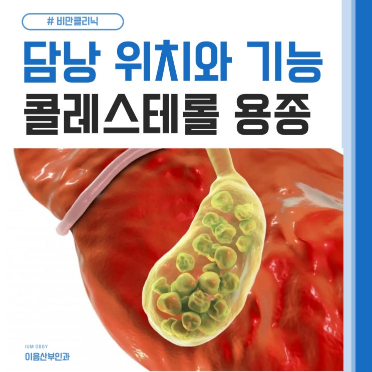  담낭 위치와 기능 콜레스테롤 담낭 용종 특징