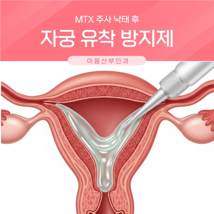  MTX 주사 낙태 후 자궁유착방지제 필요할까