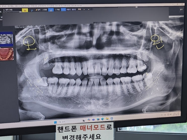  제천치과️ 《라온치과의원》 충치야 잘가렴 #충치치료 #발치 #크라운 #임플란트 #레진 #스케일링 #제천화폐 #지역화폐 #주차장 #매주목요일야간진료