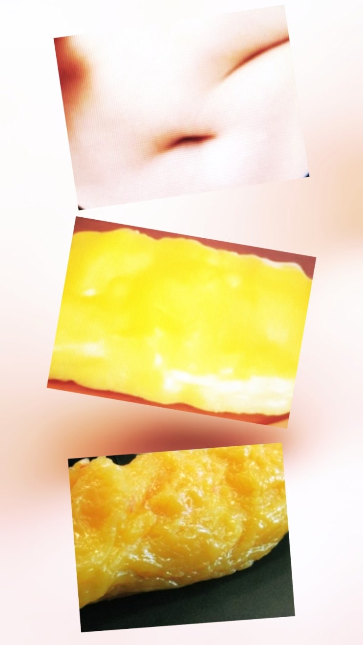  내장지방이 피하지방보다 위험한 이유! 체중 정상이어도 내장지방 과다인 경우 대처법