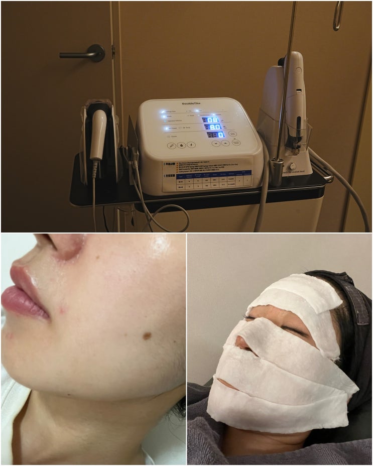  청담 피부과 추천 고주파 시술 + 모공 레이저 효과 스킨부스터 더블타이트 가격 후기