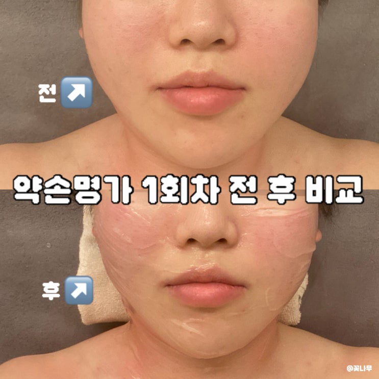  약손명가 맞춤 관리 A 이중턱 1회차 후기 | 얼굴 크기 전후 효과 솔직 비교