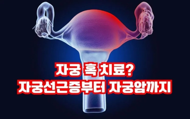  자궁 혹? 자궁선근종부터 자궁암 3종류 치료 음식까지