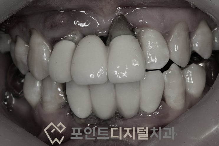  [탕정치과]  임플란트 및 보철치료 12년경과(덴티움, 신흥 luna) / 천안 아산