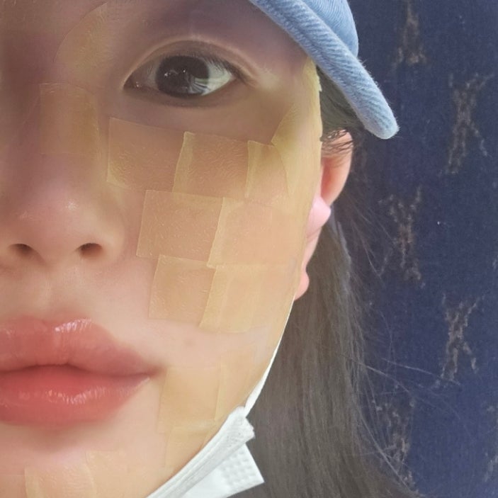 사마킬 율무크림 편평사마귀 제거 후 관리 크림으로 사용 중!