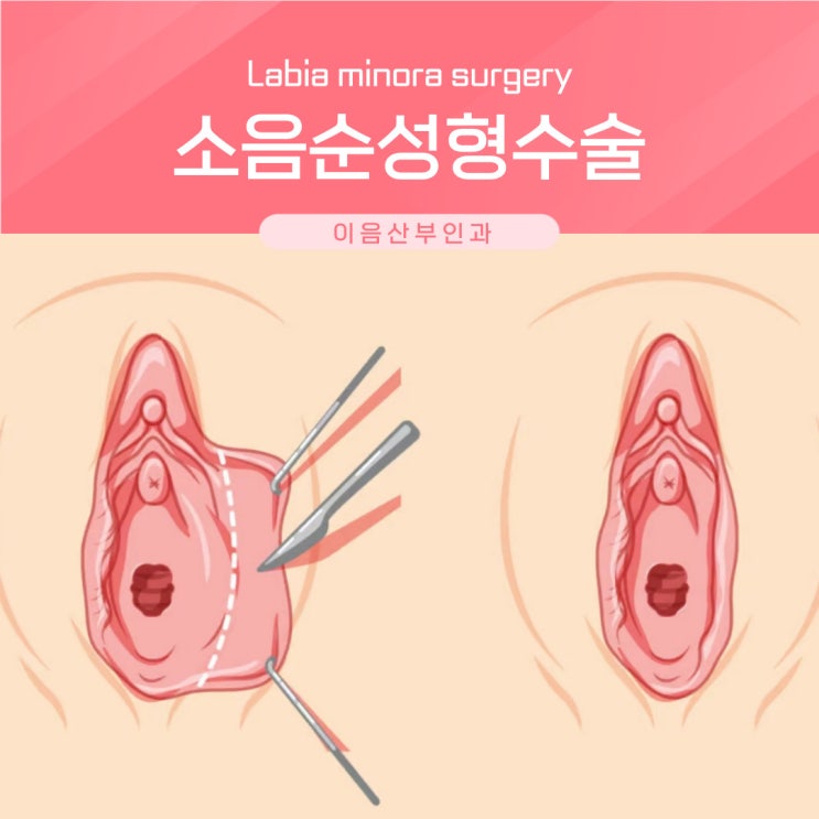  소음순성형수술 소음순 비대증 비대칭 수술 방법의 차이