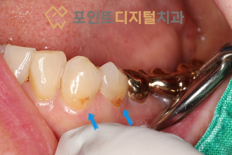  [탕정치과]  치경부 우식 레진 치료 + 뿌리쪽 숨겨진 병소 / 천안 아산 불당 배방