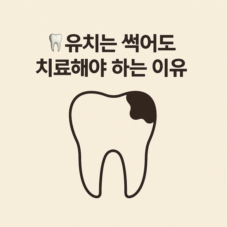   유치는 썩어도 치료해야 하는 이유