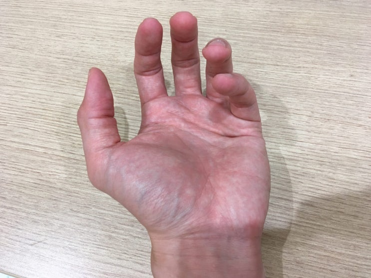  손바닥 통증, 원인부터 완화까지 관리법