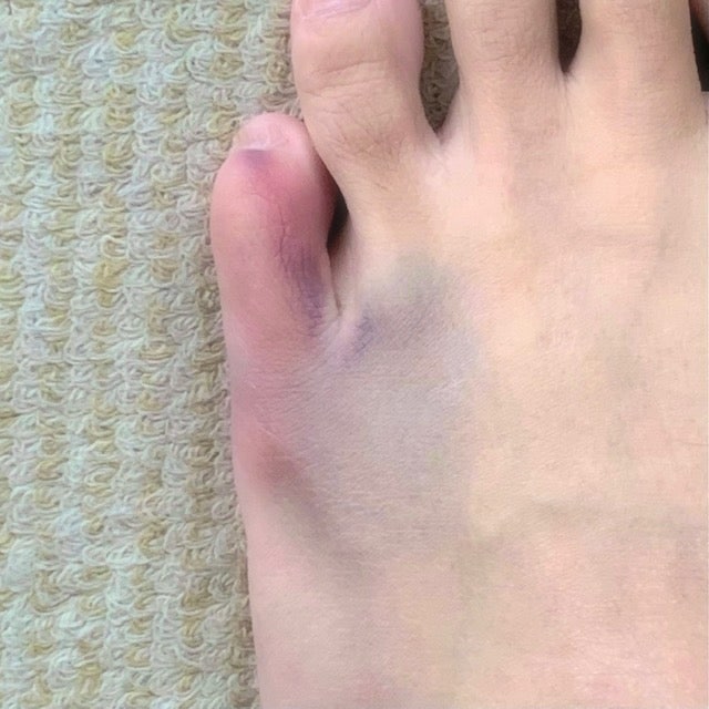  발가락 골절 초기 대처, 놓치면 더 길어집니다