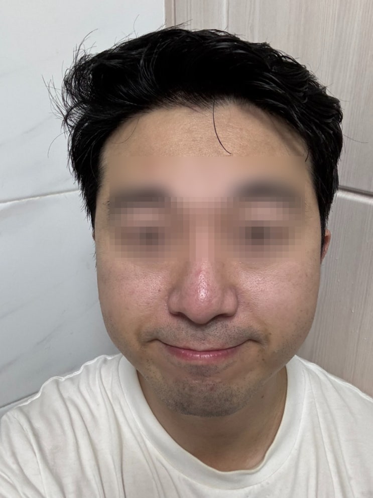  피부/팔자주름] 효과가 만족스러운 얼굴 팔자주름 시술 쥬브젠 자가진피재생술 3개월차