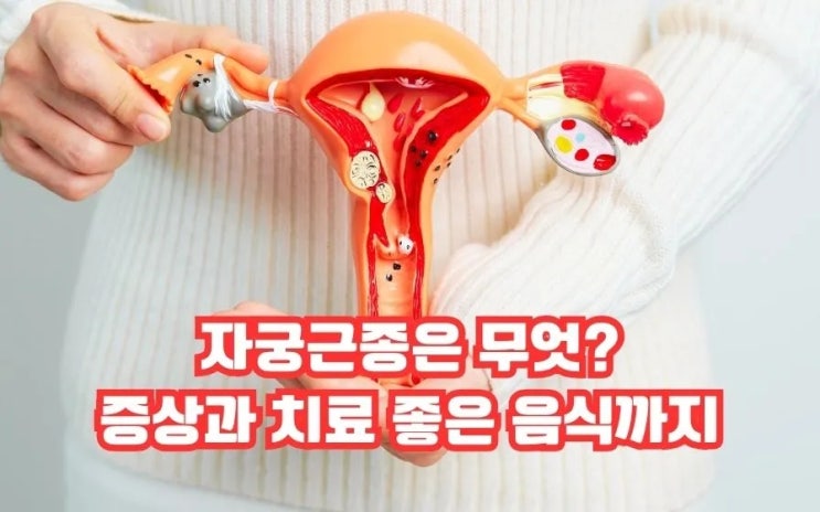  자궁근종 증상 월경과다 월경통 원인 치료 관리 음식
