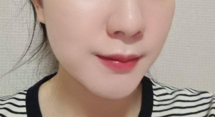  강남역 피부과 레디어스 가격 효과 앞볼 중안부 후기