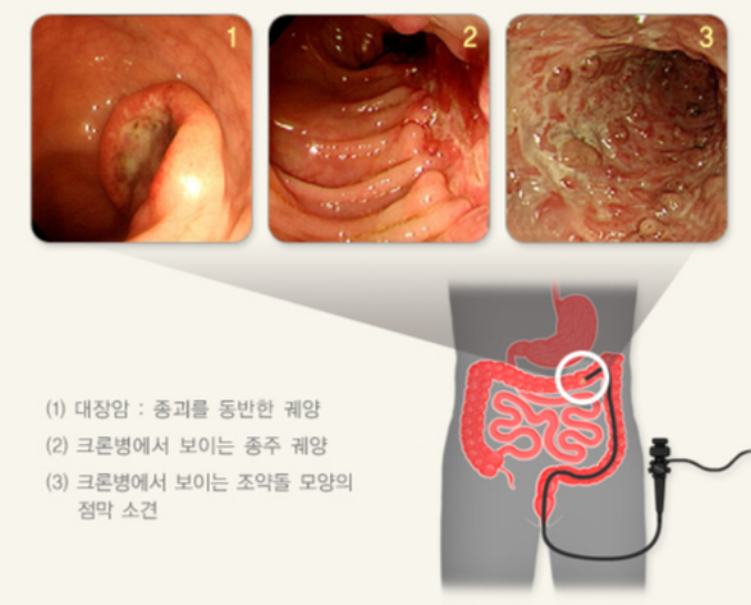  크론병(Crohn’s disease), 20대 환자 급증…원인 불명이라 더 위험한 이유