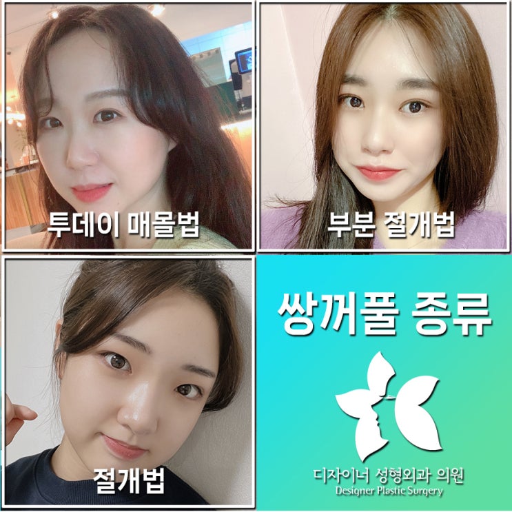  쌍꺼풀종류, 나에게 맞는 선택 방법과 병원 고르는 팁