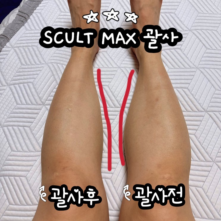  저속노화를 위한 바디 괄사 추천! 올킨스 스테인리스괄사
