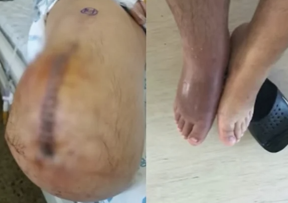  “다쳤다고 말하지마”…산재로 한쪽 다리 잃은 용접사의 눈물과 재도전