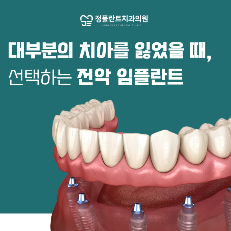  대부분의 치아를 잃었을 때, 선택하는 아산 전체 임플란트