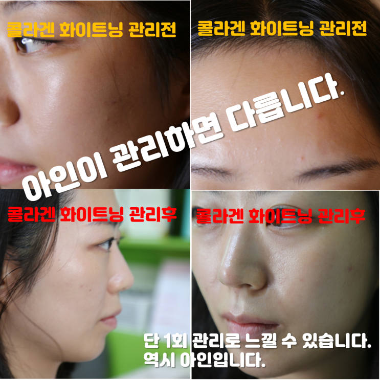  두정동피부관리 잡티 피부 미백관리를 위한 하얀얼굴 콜라겐화이트닝 관리