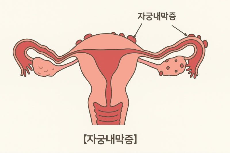 자궁내막증 수술 환자의 고민, 미레나VS임플라논