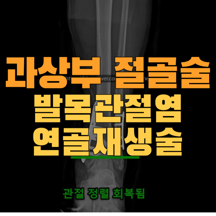  [발목관절염]과상부교정술 및 연골재생술로 관절연골 재생시키기