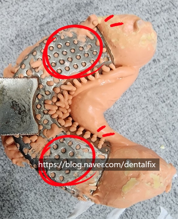  치과 알지네이트 인상채득 잘 하는 법