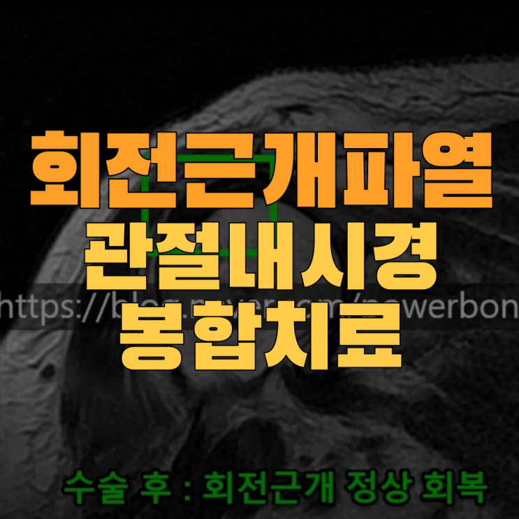  어깨 회전근개 수술이 꼭 필요한 상황, '이것' 으로 확인해야 합니다.