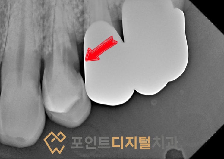  [탕정치과]  크랙과 치근우식으로 발치(발치즉시 임플란트) + 디지털 가이드 + 하이니스 디지털 보철 / 천안 아산 불당 배방