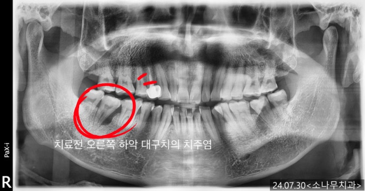 고촌치과 김포치과 소나무치과] 잇몸이 붓고 흔들리는 발치를 해야하는 치아를 치주과 전문의는 치주치료(잇몸치료)로 치아를 살릴 수 있을까?