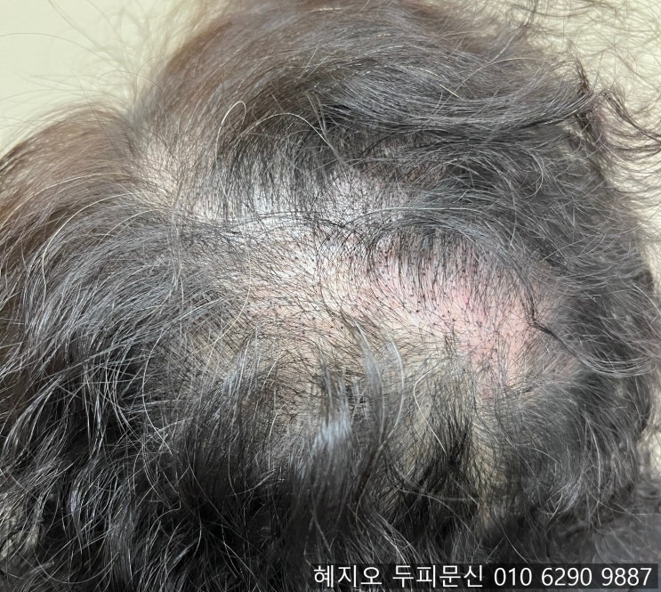  탈모예방에 좋은 두피열내리기 머리 마사지 방법