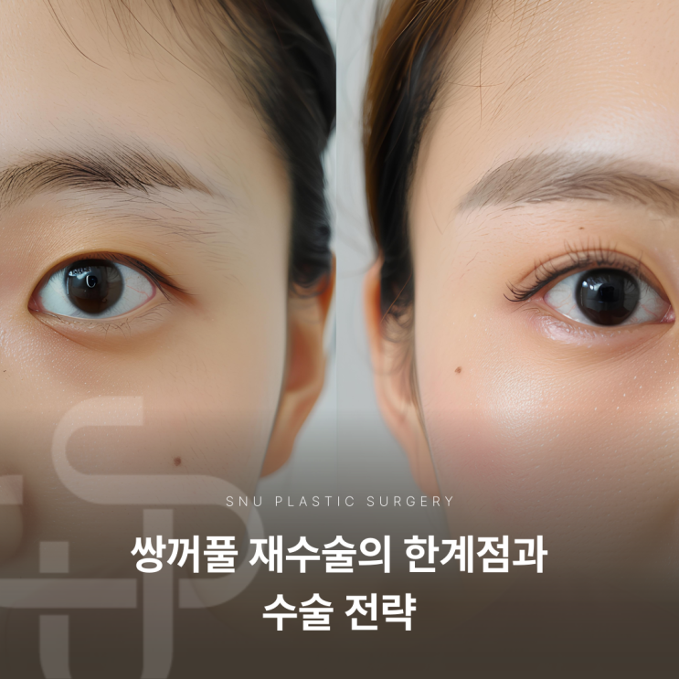  쌍꺼풀 재수술의 한계점과 수술 전략