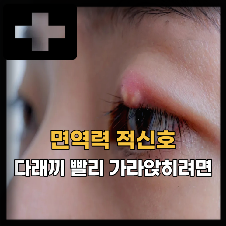 눈 다래끼 원인 증상 치료, 다래끼 안약