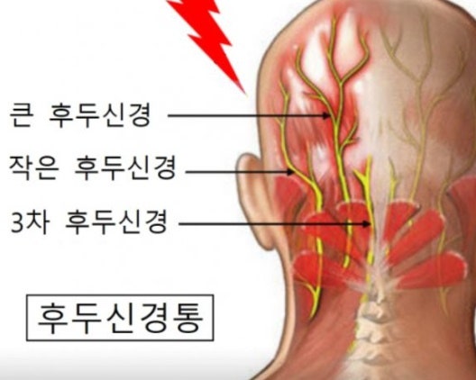 후두신경통 원인 및 증상 5가지와 치료 방법