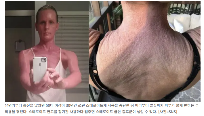  ️ 30년간 쓰던 습진 연고 끊자…“온몸이 불타는 듯” 스테로이드 금단 증후군 충격 사례